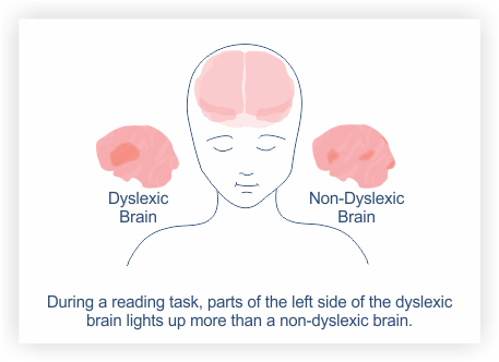 About Dyslexia